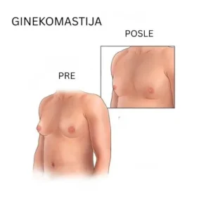 ginekomastija