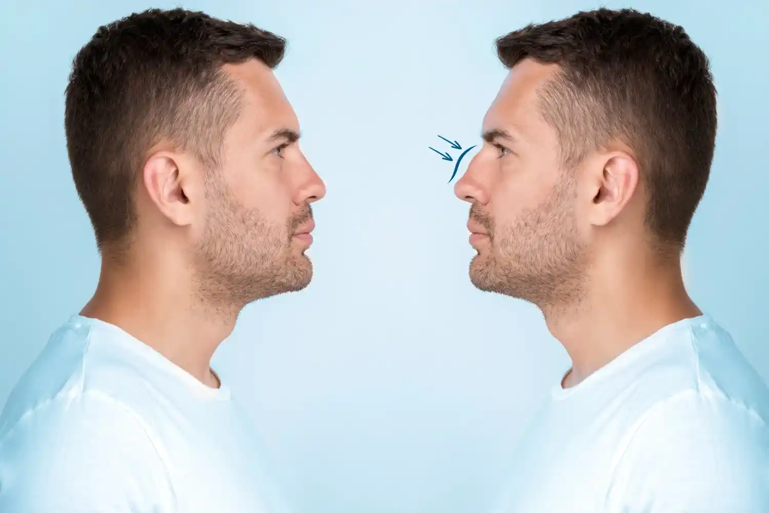 Operacija nosa — rinoplastika, Dr Ivana Kostić Beograd
